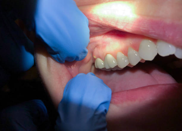 Best Emergency Treatment for Dental Infections or Abscesses in Prospect Heights, IL